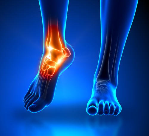 art for plantar fasciitis
