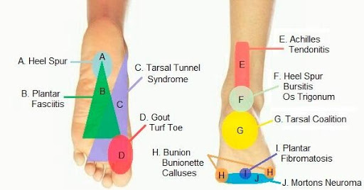 common causes of foot pain
