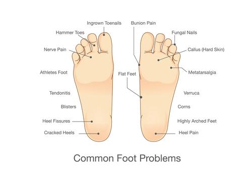physical therapist explains how to treat foot pain