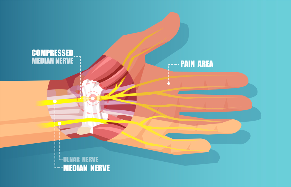 Winning The Battle Of Compressed Nerves And Neuropathic Pain