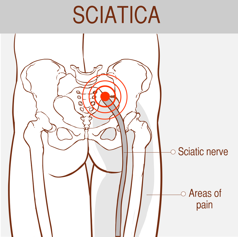 Always Hurting, No Matter What: Dealing With Sciatic Pain