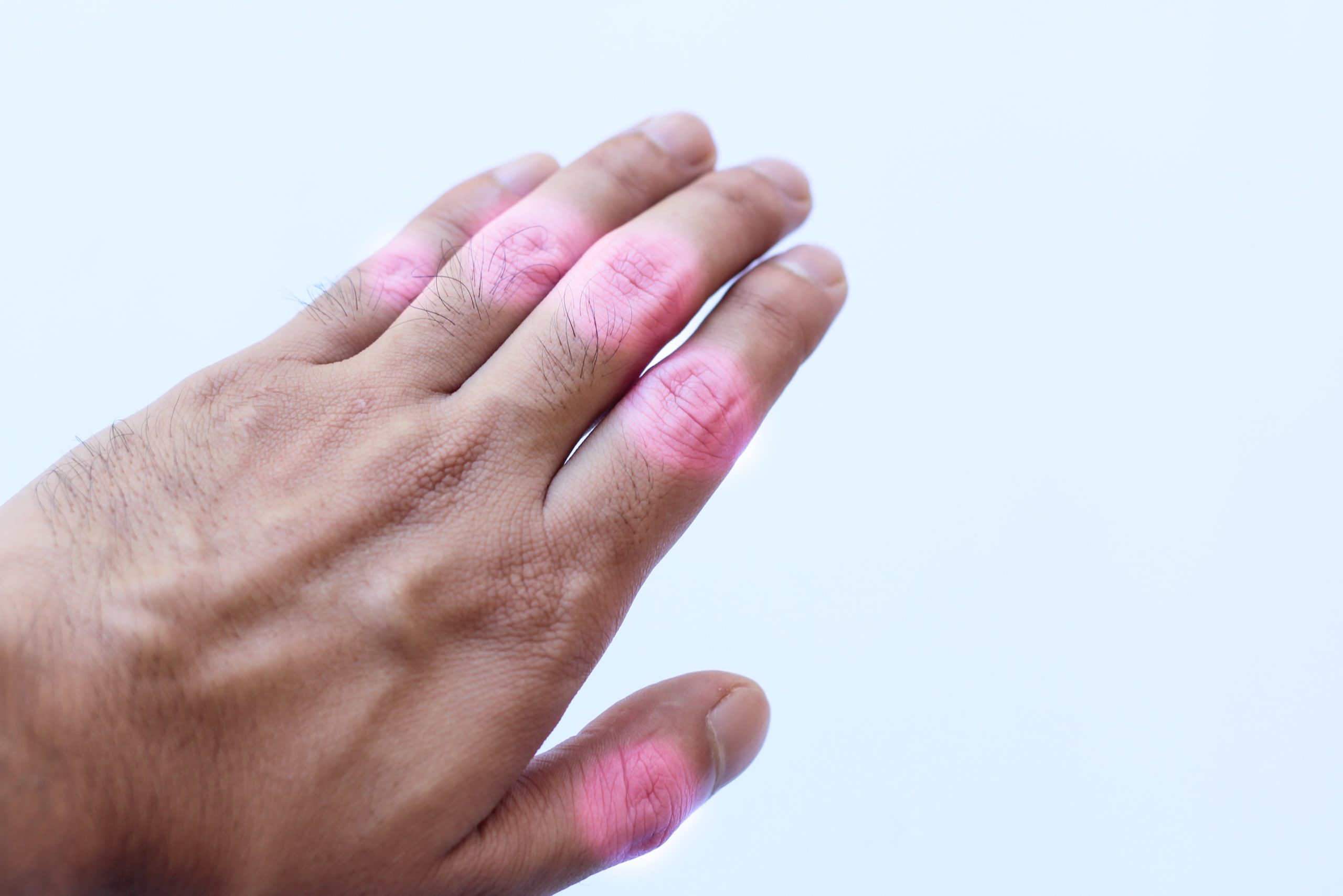 Arthritis Types And Alternative Treatment