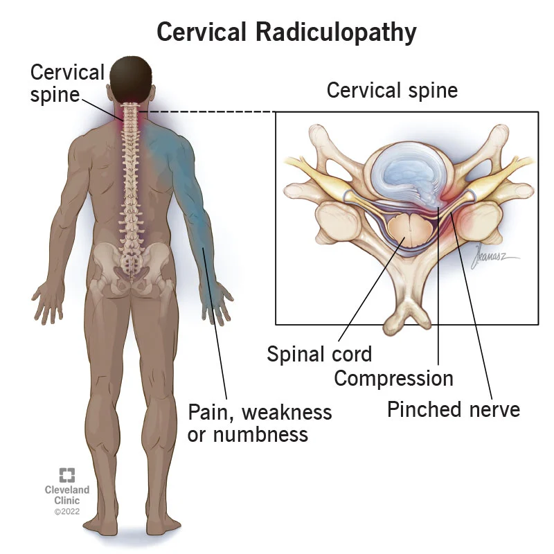 Cervical Nerve Impingement and Physical Therapy