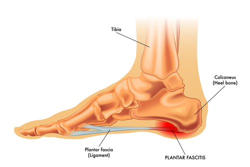 ART and Plantar Fasciitis