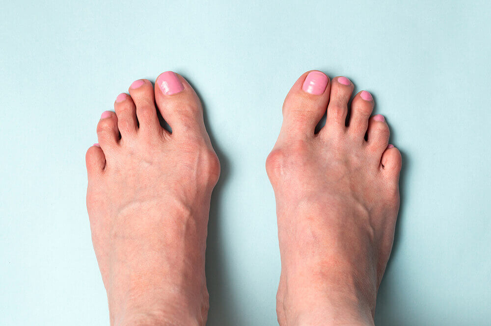 Hallux Valgus & Bunions in Santa Rosa, CA