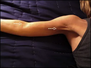 Pain Relief For Axillary Web Syndrome