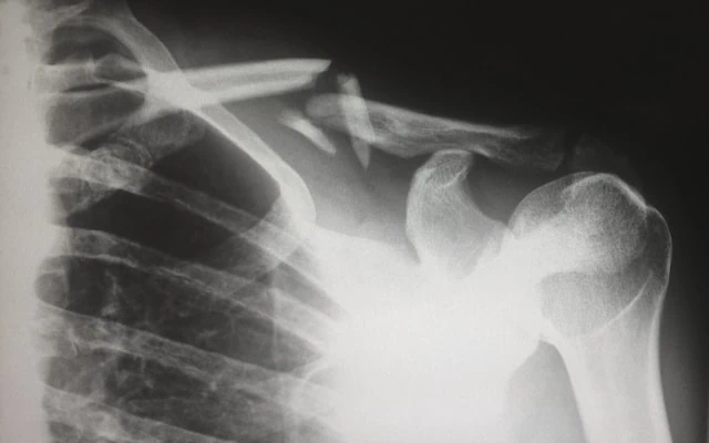 Relieving Shoulder Pain With Physical therapy