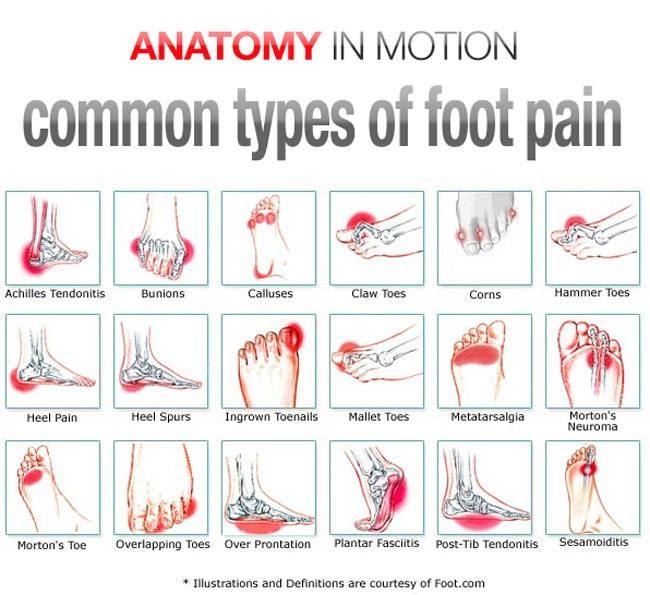 anatomy in motion can help treat common types of foot pain