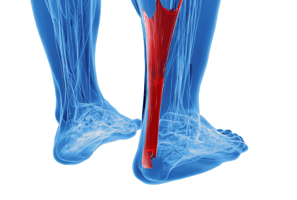 Achilles Tendonitis treatment