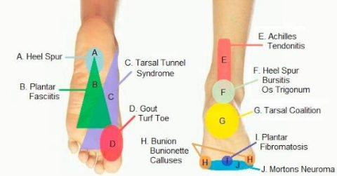 Taking A Look At Chronic Foot Pain | What Causes Foot Pain