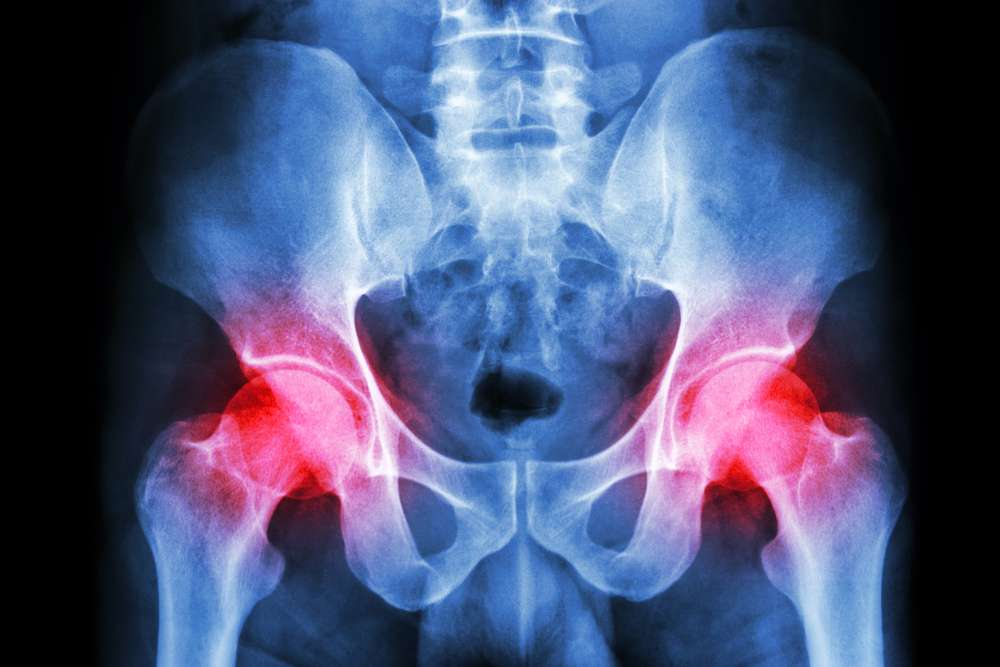 xray of person with hip pain