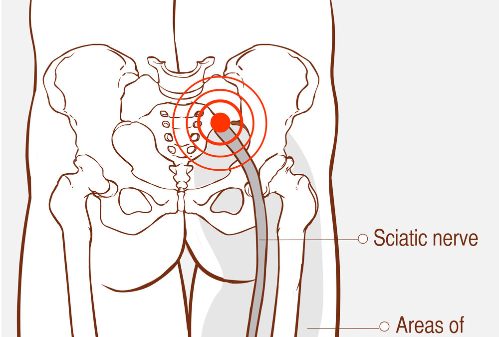 Always Hurting, No Matter What: Dealing With Sciatic Pain