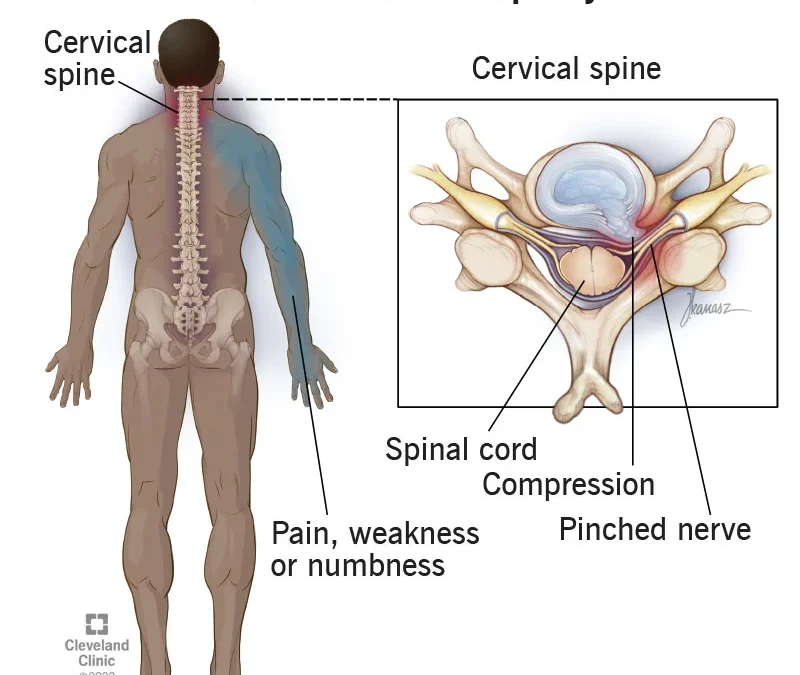 Cervical Nerve Impingement and Physical Therapy
