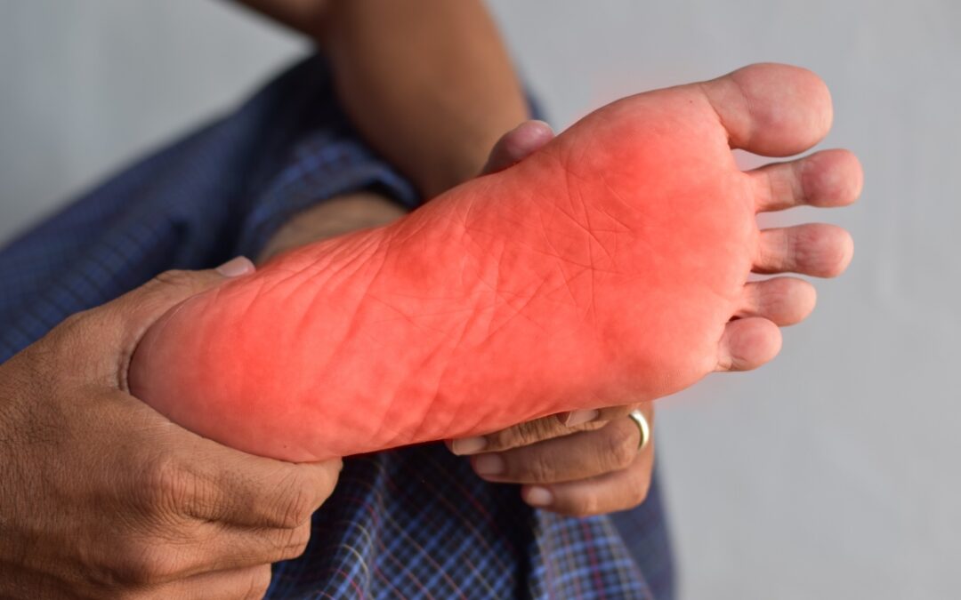 The bottom of a foot showing red indicating Plantar Fasciitis