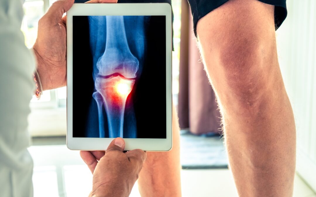 Osteoarthritis of the Knee: Managing Chronic Pain